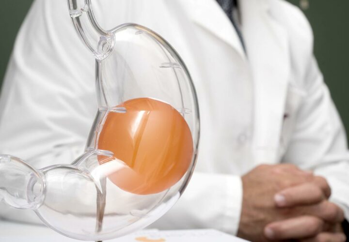 Radiofrequency-Venous-Ablation-Orbera-Intragastric-Balloon-3